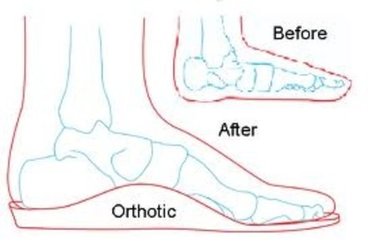 Fairfax Chiropractor | Fairfax chiropractic Custom Foot Orthotics |  VA |